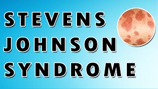 Stevens Johnson Syndrome Symptoms Treatment and Causes [upl. by Pasol]