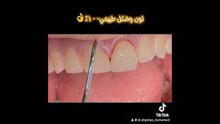 ٤ عدسات بلون طبيعي عدلنا الأسنان dentist اسنان تجميلveneers dentist viralvideo videos explo [upl. by Alitha808]