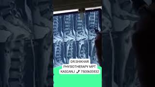 drshikhar physiotherapy MPT kasganj how see MRI call 📞 7500603832 dr [upl. by Aiehtela]