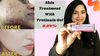 TRETINOIN Gel 004 Review Before And After Tretinoin Cream Review  RetinoA review myexperience [upl. by Prospero]