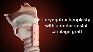 Medical Animation Anterior Cricoid Split  Cincinnati Childrens [upl. by Hathaway]