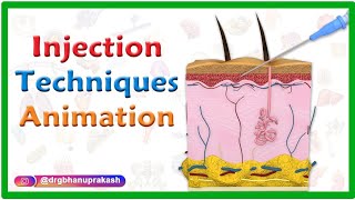 Injection Techniques Animation  Intradermal Intramuscular Subcutaneous and Z track [upl. by Xerxes]