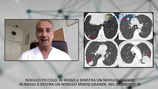 Approccio Diagnostico ai Noduli Polmonari [upl. by Alig]