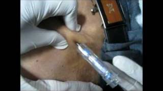 How To Give Goserelin Injection By Subcutaneous Mode [upl. by Keir]