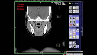 CT Neck Axial Coronal and Sagittal Image [upl. by Patrizia]