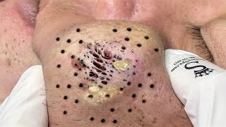 Blackhead Removal With Sac Dep Spa 1000339 [upl. by Vinny]