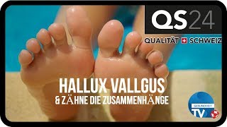 Der Hallux Valgus  Zahnmedizin  QS24 02072019 [upl. by Eldreda515]