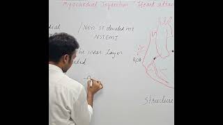 myocardial Infarction Heart attack NSTEMI  subendocardial Infarction [upl. by Assiar]