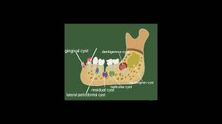 Cyst of the jaw cyst dentigerous cyst shorts dentist classification definition [upl. by Kamilah]