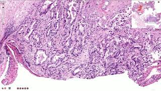 Adenocarcinoma of the Esophagus  Histopathology [upl. by Luttrell810]