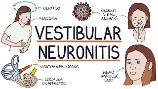 Understanding Vestibular Neuronitis [upl. by Corinna]