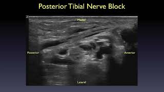 AEUS Lower Nerve Block 325 [upl. by Akinit]