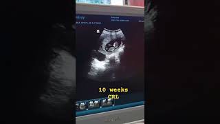 10 weeks CRLultrasound doctordoctors health hospitalpregnancy pregnant baby babygirl [upl. by Hay289]