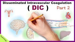 DIC Disseminated Intravascular Coagulation  Part 2 [upl. by Domph]