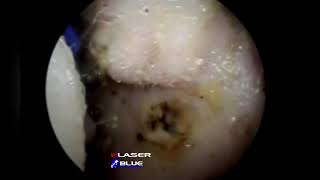 feline apocrine cysts cystomatosis [upl. by Moberg]