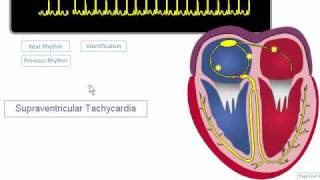 ECG Rhythm Review SVT Atrial Fibrillation Atrial Flutter [upl. by Trinatte487]