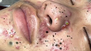 Big Cystic Acne Blackheads Extraction Blackheads amp Milia Whiteheads Removal Pimple Popping  7044 [upl. by Papagena]