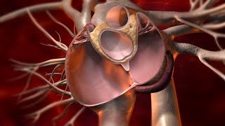 What is PFO  Closure of Patent Foramen Ovale to treat Cryptogenic Stroke [upl. by Lachlan508]