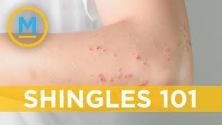 Are you at risk for shingles  Your Morning [upl. by Redla693]