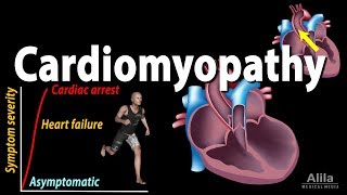 Cardiomyopathy animation [upl. by Adams]