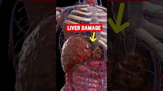 8 Sings of Liver Failure  Liver Damage P2 [upl. by Dahraf]