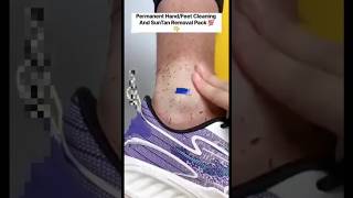 🔥Get Fair Feet  Easy Suntan Removal Pack At Home RemoveSuntan shortsytshortssuntandiyviral [upl. by Al]