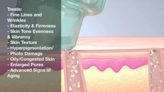 Hydrapeel Treatment Explained [upl. by Iorgo631]