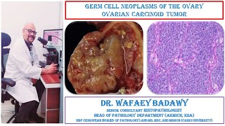 GERM CELL NEOPLASMS OF THE OVARY OVARIAN CARCINOID TUMOR BY DR WAFAEY BADAWY [upl. by Drahsar775]