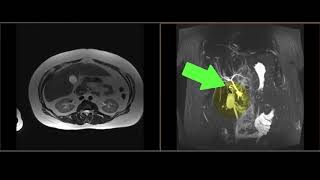 Gallbladder  Normal Anatomy  MRI Online [upl. by Lipps]