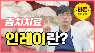 인레이는 무엇일까요  바른치과생활 ㅣ 인레이 크라운 충치치료 [upl. by Johnnie256]