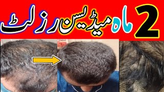 2 months Medicine Result  Hairfall Medicine  How to Regrowth Hair [upl. by Nnaylrebmik]