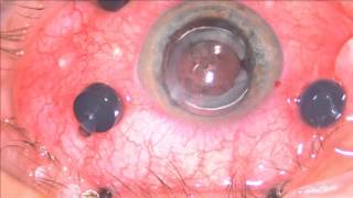 Oxane HD removal with epiretinal membrane peeling Live DrMishev [upl. by Abehshtab]