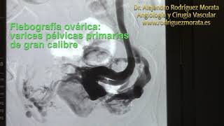 Embolización de Varices Pélvicas [upl. by Mannes]