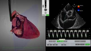 HeartWorks Cardiac Tamponade [upl. by Kirt]