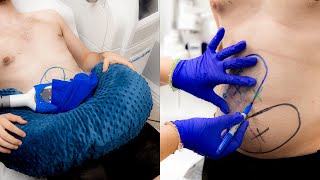 Coolsculpting for men  Body Sculpting in London [upl. by Muhcan]