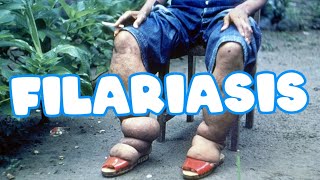 Filariasis  Elephantiasis  wuchereria bancrofti  Life cycle  clinical features  Lab diagnosis [upl. by Gaeta]