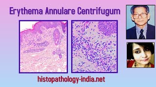 Pathology of Erythema Annulare Centrifugum  Dr Sampurna Roy MD dermpath dermatopathology [upl. by Revolc]