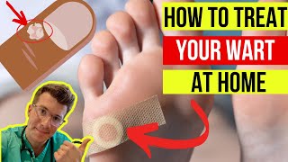 Doctor explains how to treat WARTS at home plus when to seek medical attention [upl. by Yrol]