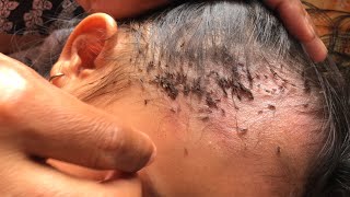 Removing Thousands Of Lice From Long Hair How To Remove It [upl. by Piscatelli]