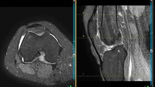 Localized nodular synovitis [upl. by Amaerd]