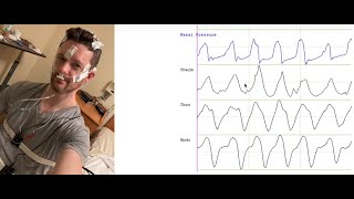 Orientation to Polysomnography [upl. by Johannah]