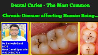 Dental Caries  The Most Common Chronic Disease affecting Human Being [upl. by Ajay]