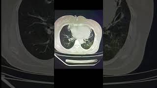 Cystic Bronchiectasis  Chest Ct scan Radiology ctscan radiology shorts [upl. by Nocaed]