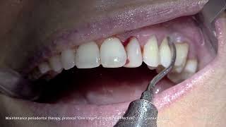 PROPHYLAXIS  Dr Gianluca Russo  Maintenance periodontal therapy [upl. by Wiburg371]