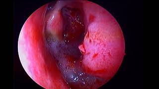 Left inverted papilloma with sinonasal polyposis [upl. by Narahs]