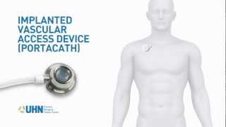 PortaCath Implanted Vascular Access Device [upl. by Flynn]