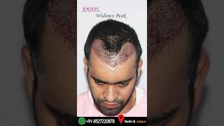 The best Hair Transplant Results in India by Dr Suneet Soni at Medispa Hair Transplant Centre [upl. by Herman]