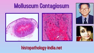 Pathology of Molluscum Contagiosum  Dr Sampurna Roy MD dermpath dermatopathology [upl. by Elagibba]