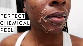 I TRIED A CHEMICAL PEEL  Full Process Before and After Dark Marks amp Acne Scars [upl. by Allicsirp403]