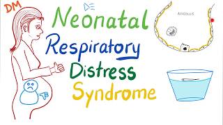 Neonatal Respiratory Distress Syndrome NRDS  Pediatrics  Pulmonology [upl. by Labinnah]